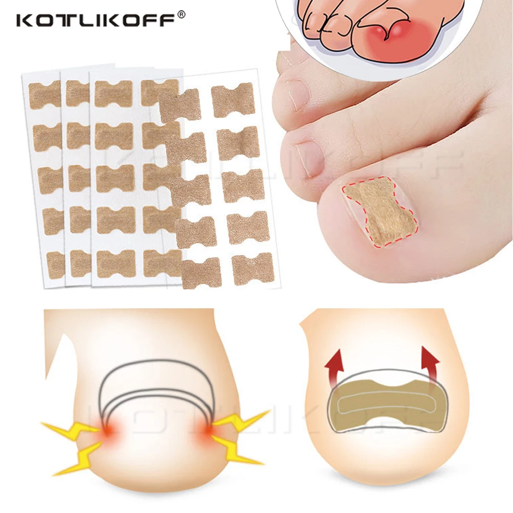 Top Trends: KOTLIKOFF Toenail Correction Stickers Ingrown Toenail Stickers Paronychia Treatment Pedicure Toe Nail Care Corrector Patch Shoppable Styles