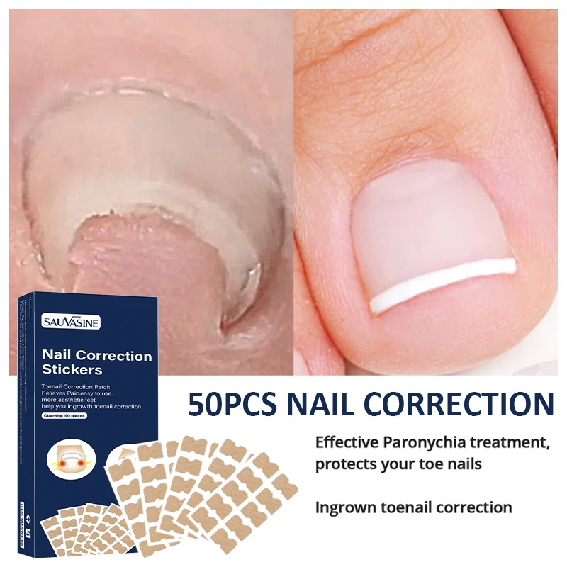 Top Trends: 50pcs Nail Correction Stickers Ingrown Toenail Corrector Patches Waterproof Paronychia Treatment Recover Corrector Pedicure Tool Shoppable Styles